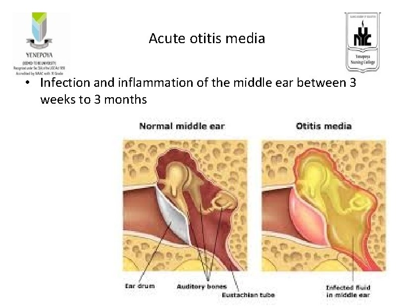 Acute otitis media • Infection and inflammation of the middle ear between 3 weeks