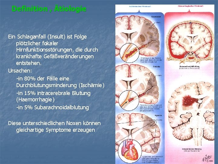 Definition , Ätiologie Ein Schlaganfall (Insult) ist Folge plötzlicher fokaler Hirnfunktionsstörungen, die durch krankhafte