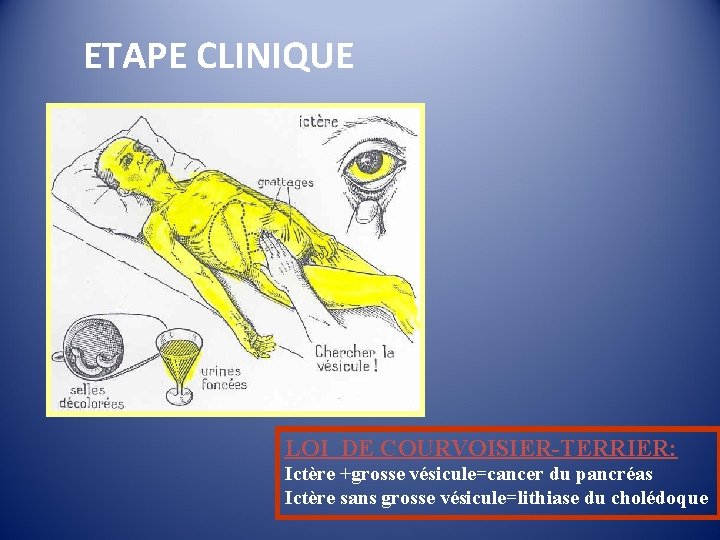 ETAPE CLINIQUE LOI DE COURVOISIER-TERRIER: Ictère +grosse vésicule=cancer du pancréas Ictère sans grosse vésicule=lithiase