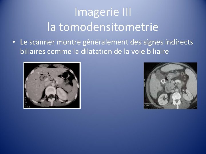 Imagerie III la tomodensitometrie • Le scanner montre généralement des signes indirects biliaires comme