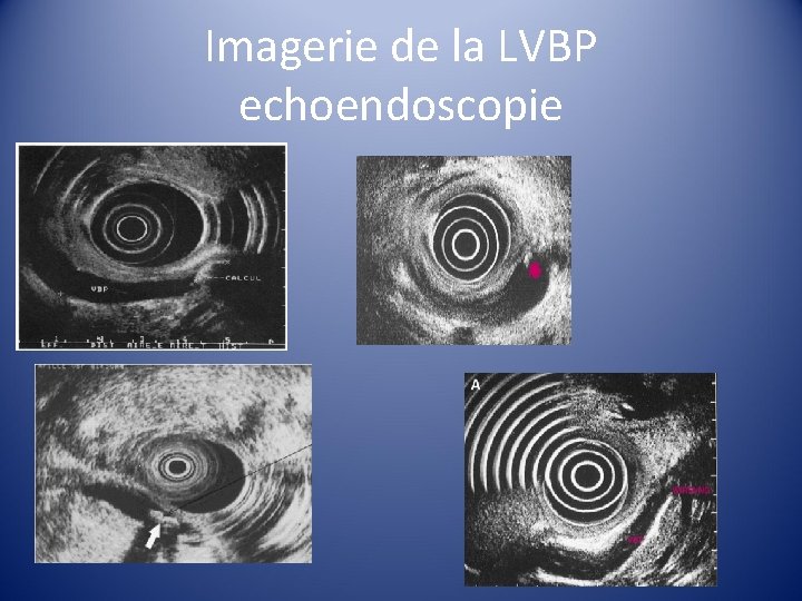 Imagerie de la LVBP echoendoscopie 