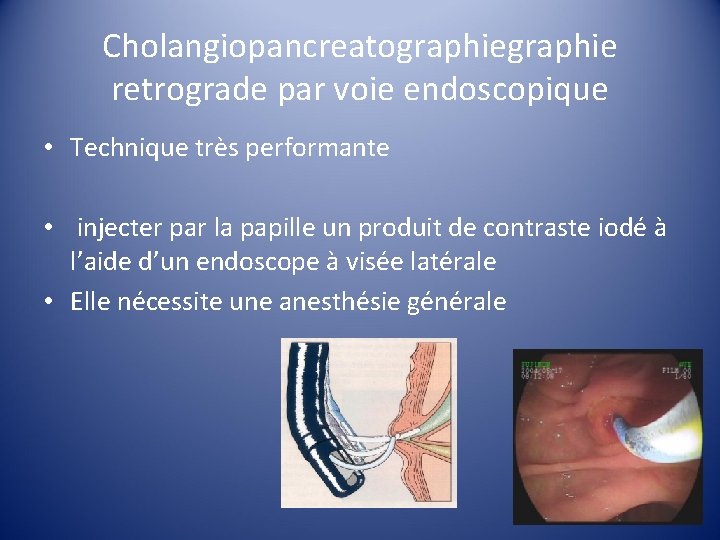 Cholangiopancreatographie retrograde par voie endoscopique • Technique très performante • injecter par la papille