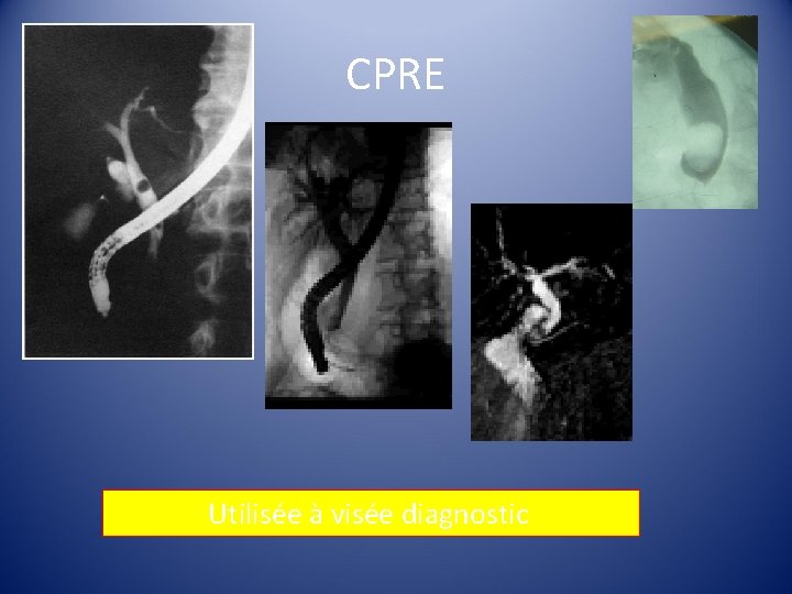 CPRE Utilisée à visée diagnostic 