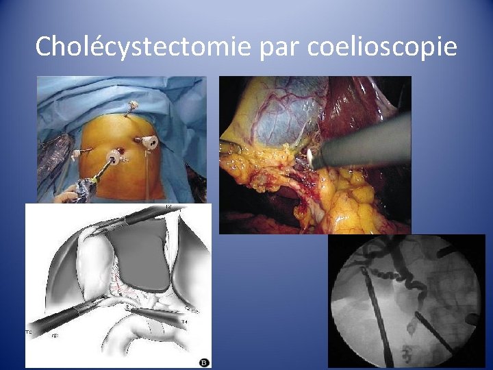 Cholécystectomie par coelioscopie 