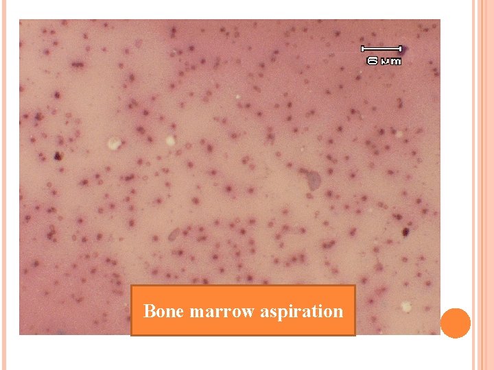 Bone marrow aspiration 