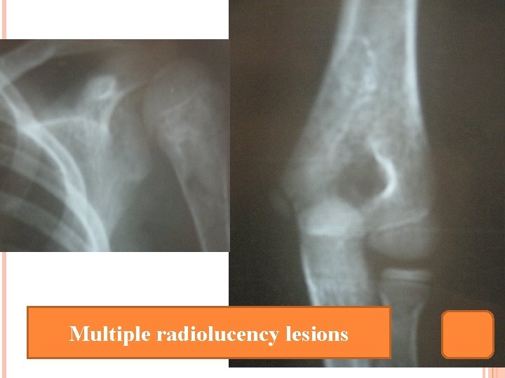 Multiple radiolucency lesions 