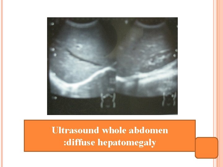 Ultrasound whole abdomen : diffuse hepatomegaly 