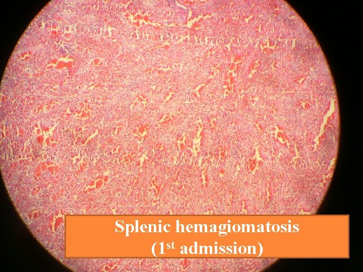 Splenic hemagiomatosis (1 st admission) 