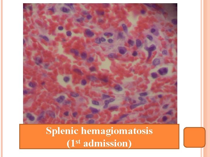 Splenic hemagiomatosis (1 st admission) 