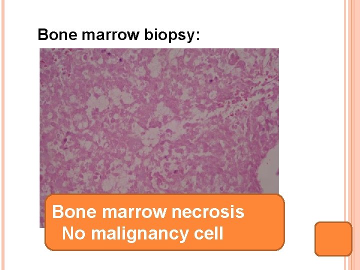 Bone marrow biopsy: Bone marrow necrosis No malignancy cell 