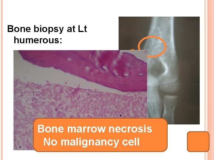 Bone biopsy at Lt humerous: Bone marrow necrosis No malignancy cell 