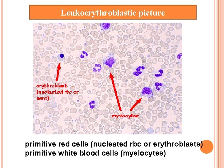 Leukoerythroblastic picture primitive red cells (nucleated rbc or erythroblasts) primitive white blood cells (myelocytes)