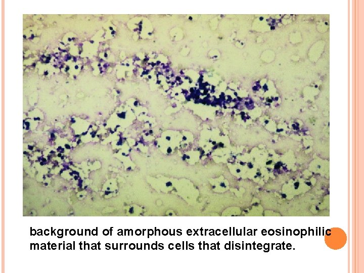 background of amorphous extracellular eosinophilic material that surrounds cells that disintegrate. 