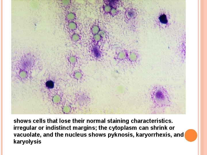 shows cells that lose their normal staining characteristics. irregular or indistinct margins; the cytoplasm