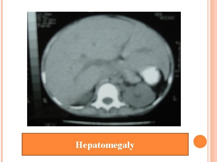 Hepatomegaly 