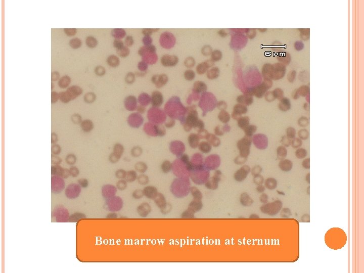 Bone marrow aspiration at sternum 
