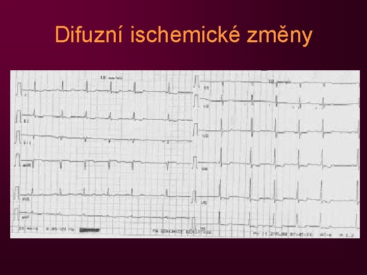 Difuzní ischemické změny 