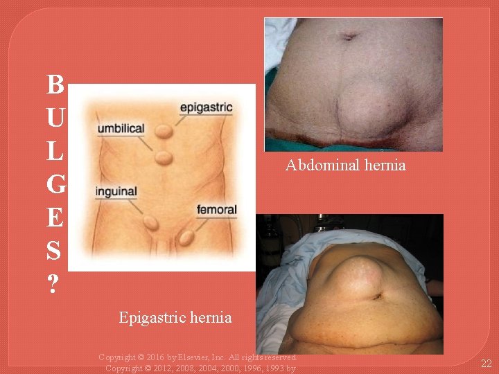 B U L G E S ? Abdominal hernia Epigastric hernia Copyright © 2016