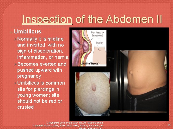 Inspection of the Abdomen II Umbilicus Ø Normally it is midline and inverted, with