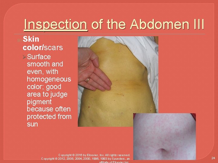 Inspection of the Abdomen III Skin color/scars ØSurface smooth and even, with homogeneous color;