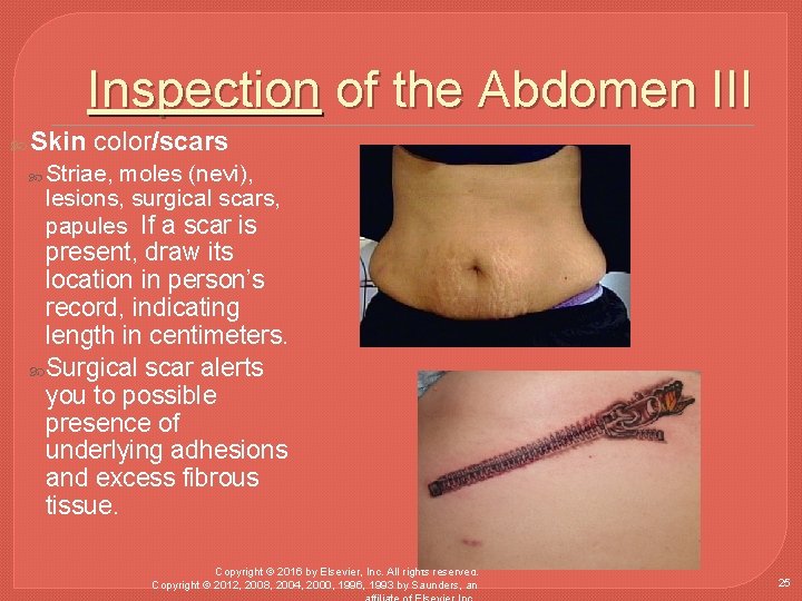 Inspection of the Abdomen III Skin color/scars Striae, moles (nevi), lesions, surgical scars, papules