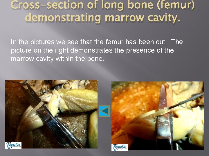 Cross-section of long bone (femur) demonstrating marrow cavity. In the pictures we see that