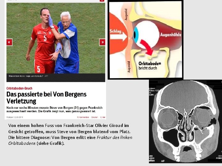 Von einem hohen Fuss von Frankreich-Star Olivier Giroud im Gesicht getroffen, muss Steve von