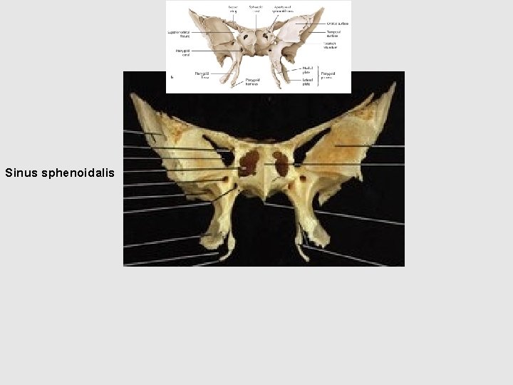 Sinus sphenoidalis 