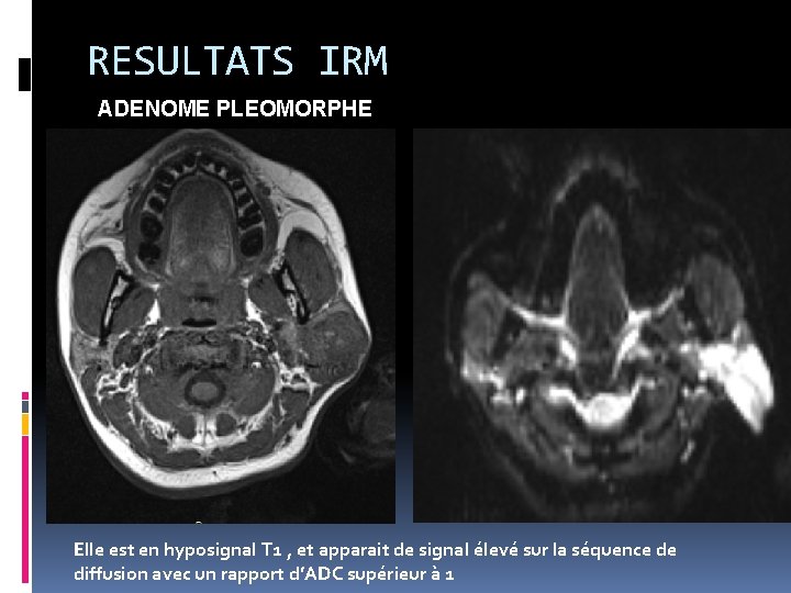 CONTRIBUTION DE LIRM DANS LA CARACTERISATION DES TUMEURS