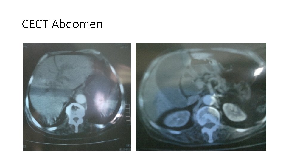 CECT Abdomen 