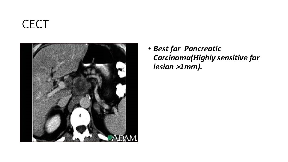 CECT • Best for Pancreatic Carcinoma(Highly sensitive for lesion >1 mm). 