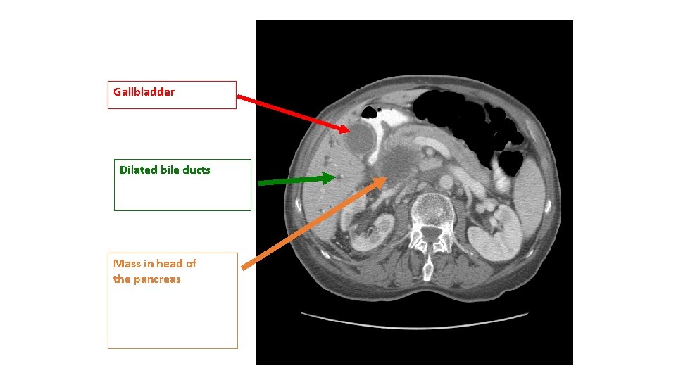 Gallbladder Dilated bile ducts Mass in head of the pancreas 
