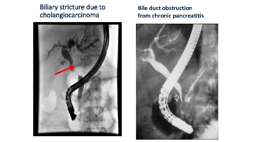 Biliary stricture due to cholangiocarcinoma Bile duct obstruction from chronic pancreatitis 