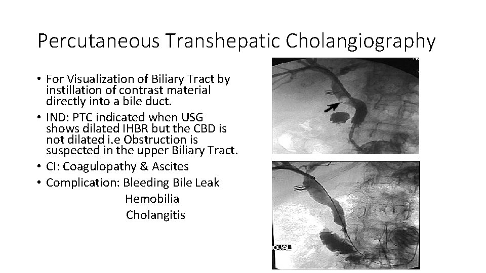 Percutaneous Transhepatic Cholangiography • For Visualization of Biliary Tract by instillation of contrast material