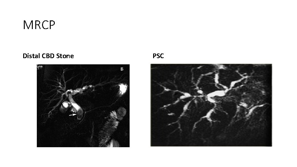 MRCP Distal CBD Stone PSC 