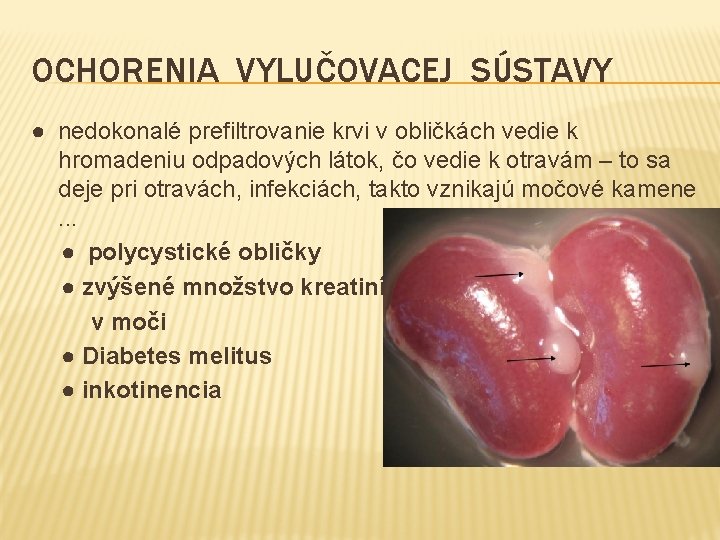 OCHORENIA VYLUČOVACEJ SÚSTAVY ● nedokonalé prefiltrovanie krvi v obličkách vedie k hromadeniu odpadových látok,