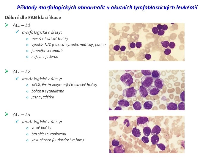 Příklady morfologických abnormalit u akutních lymfoblastických leukémií Dělení dle FAB klasifikace Ø ALL –