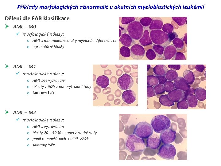 Příklady morfologických abnormalit u akutních myeloblastických leukémií Dělení dle FAB klasifikace Ø AML –