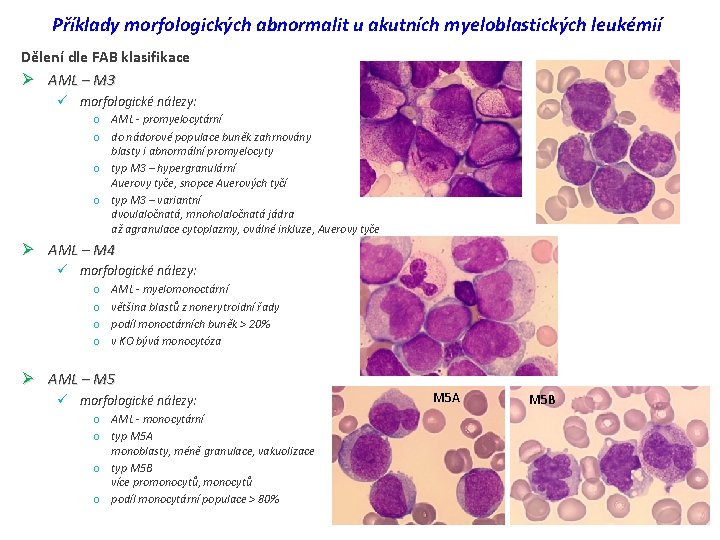 Příklady morfologických abnormalit u akutních myeloblastických leukémií Dělení dle FAB klasifikace Ø AML –
