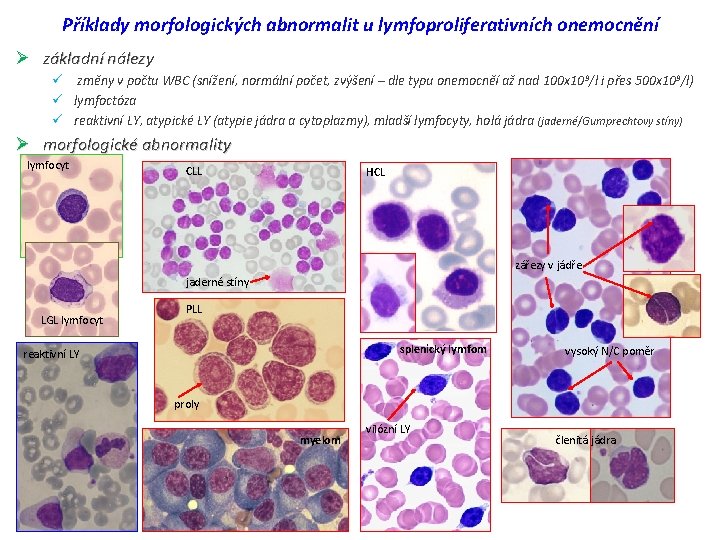 Příklady morfologických abnormalit u lymfoproliferativních onemocnění Ø základní nálezy ü změny v počtu WBC