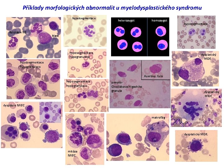 Příklady morfologických abnormalit u myelodysplastického syndromu hypersegmentace dysplázie NE heterozygot homozygot hyposegmentace blast hyposegmentace