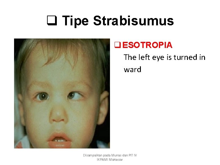 q Tipe Strabisumus q ESOTROPIA The left eye is turned in ward Disampaikan pada