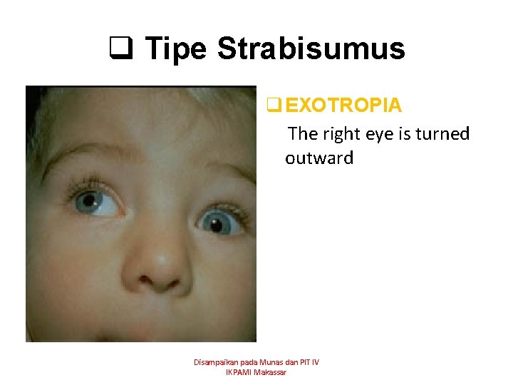 q Tipe Strabisumus q EXOTROPIA The right eye is turned outward Disampaikan pada Munas