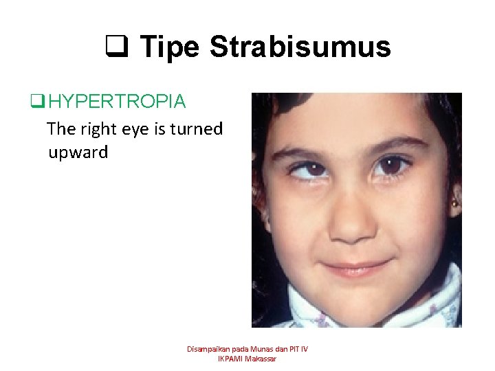 q Tipe Strabisumus q HYPERTROPIA The right eye is turned upward Disampaikan pada Munas