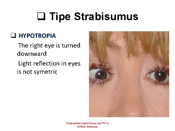 q Tipe Strabisumus q HYPOTROPIA The right eye is turned downward Light reflection in