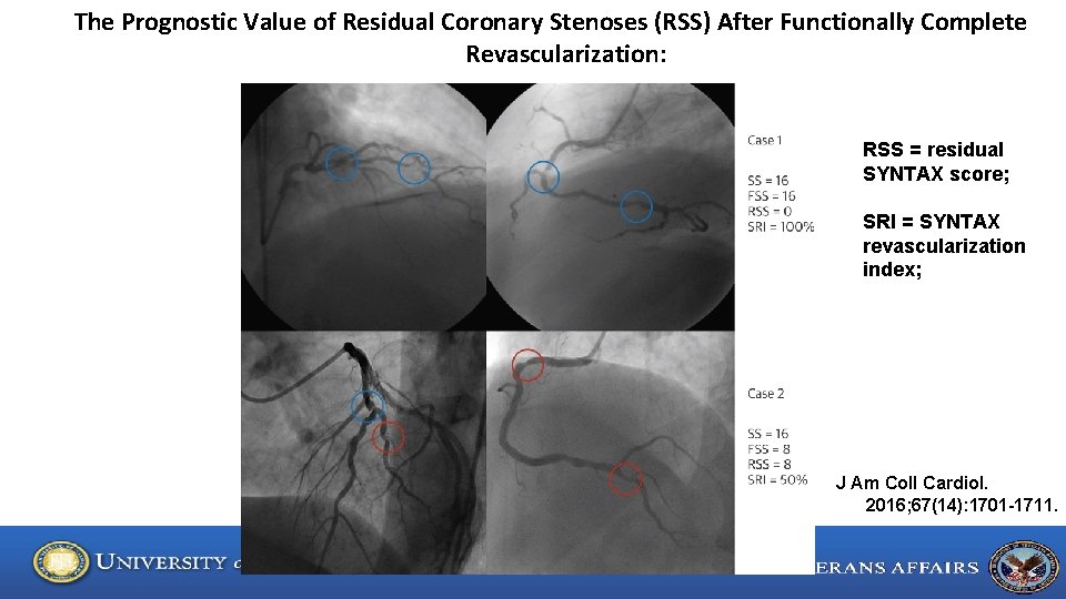 The Prognostic Value of Residual Coronary Stenoses (RSS) After Functionally Complete Revascularization: RSS =