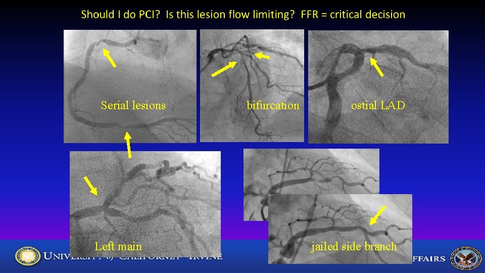 Serial lesions Left main bifurcation ostial LAD jailed side branch 
