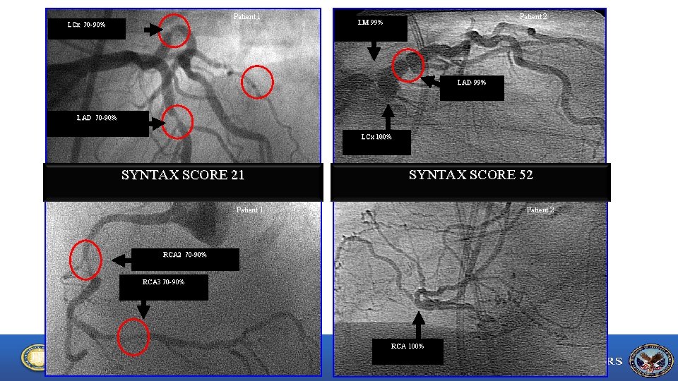 Patient 1 LCx 70 -90% Patient 2 LM 99% LAD 70 -90% LCx 100%