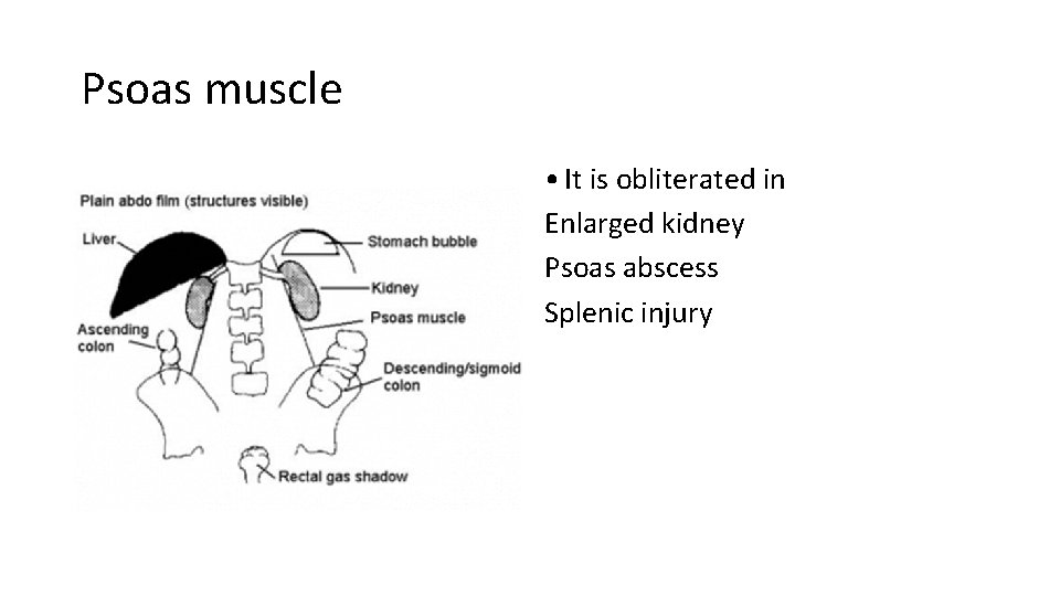 Psoas muscle • It is obliterated in Enlarged kidney Psoas abscess Splenic injury  Psoas muscle • It is obliterated in Enlarged kidney Psoas abscess Splenic injury
