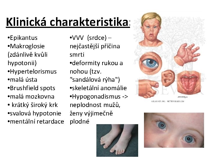 Klinická charakteristika: • Epikantus • Makroglosie (zdánlivě kvůli hypotonii) • Hypertelorismus • malá ústa